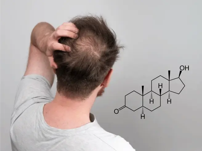 Un homme vu de dos, portant un t-shirt gris, se gratte la tête et révèle une calvitie naissante sur le sommet du crâne. À côté, une formule chimique représentant la molécule de DHT (dihydrotestostérone).